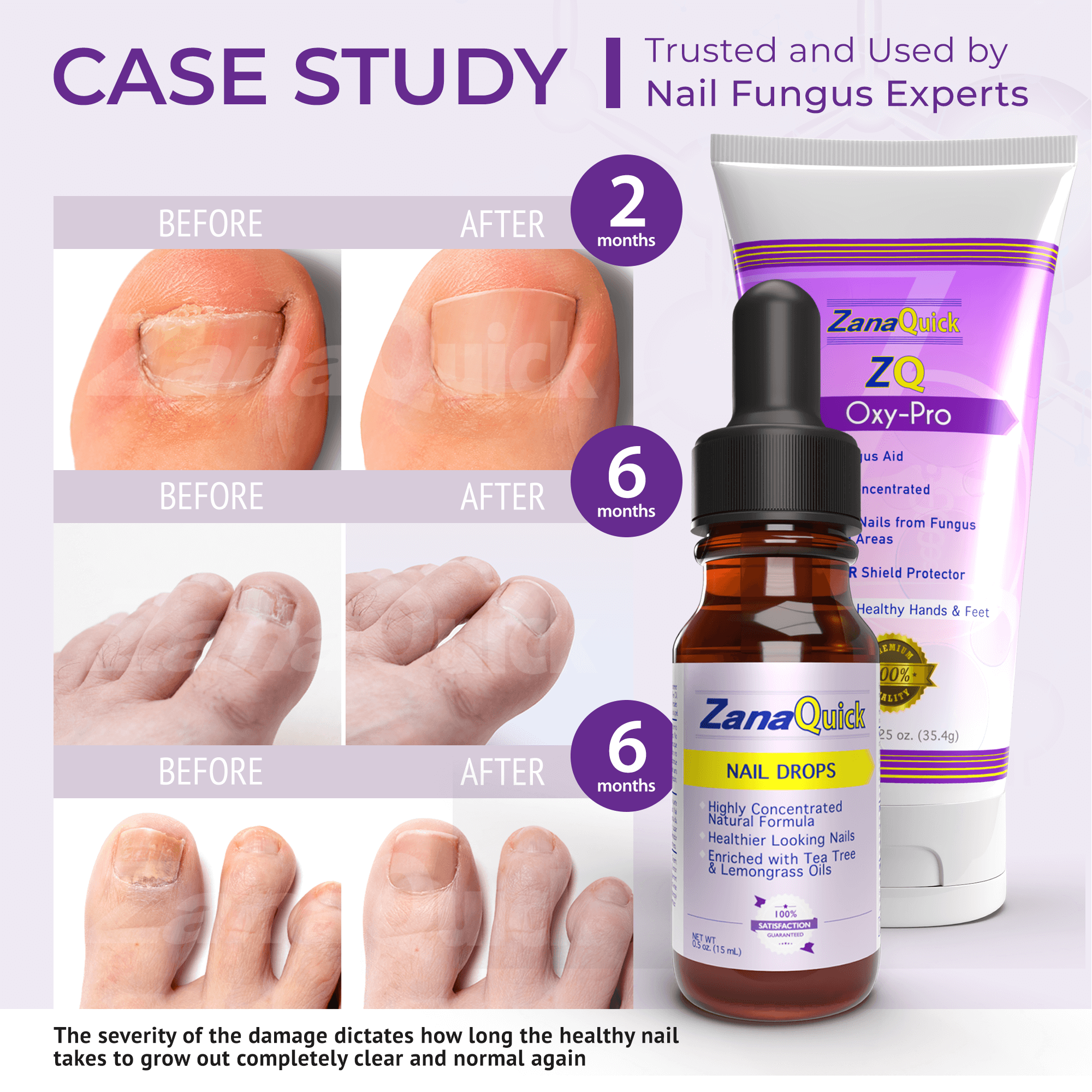 ZQ Fungal Toenail Solution